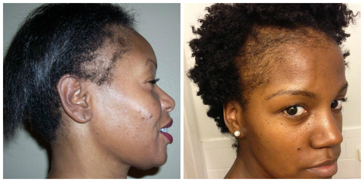 Protect Your Hair Edges with Right Installations -Don’t Go from Beauty to “the Beast” with Wrong Hair Installations 