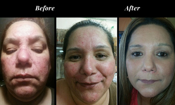 Subject 41, 35 yrs. old, 4 weeks of use - 2x per day, second image is 30 day without makeup, 3rd image is 30 days with makeup.