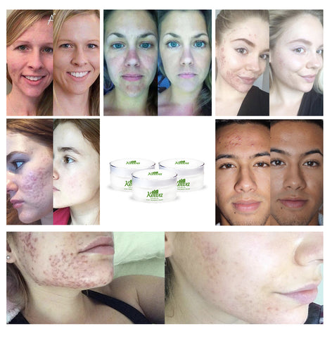Buy 2 get 1 free keeva's acne treatment cream