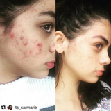 Clarifying Acne Face Wash