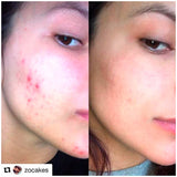 1oz ACNE CREAM