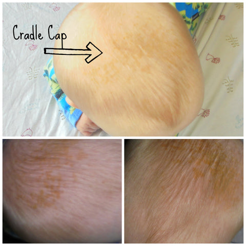 7 month old cradle cap