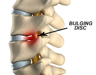 Bulging disk sciatica treatment