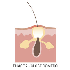 Acne Phase 2 - Closed Comedo