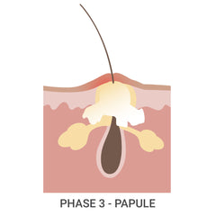 Acne Phase 3 - Papule