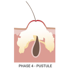 Acne Phase 4 - Pustule