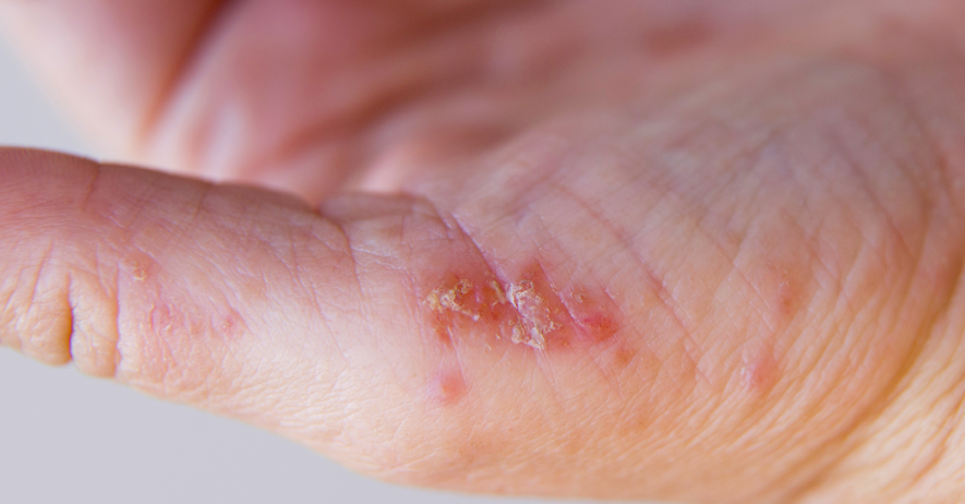 Contact dermatitis caused by cheap disposable gloves