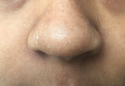 Example of Seborrheic Dermatitis of Facial Dandruff 