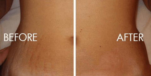 before and after stretch mark lotion cream