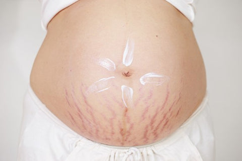 ic: What are stretch marks & how can i help them fade?