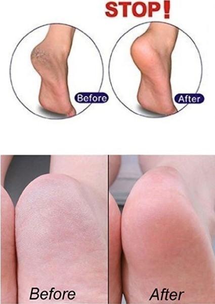 fix dry cracked heels