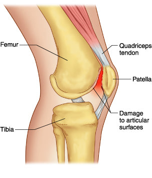 patellofemoral-syndrome