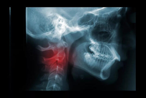 Neck Fracture