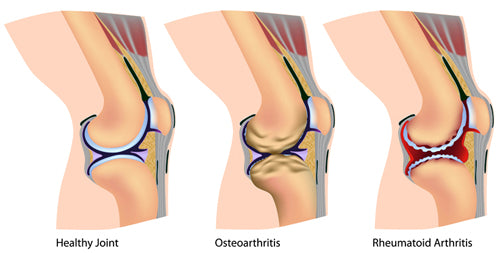 knee-arthritis