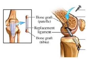 ACL reconstructive surgery