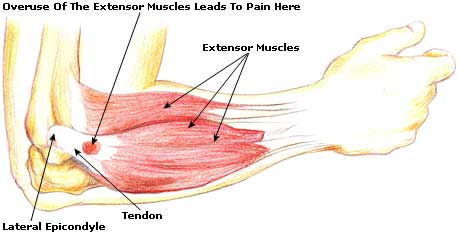 What is Tennis Elbow