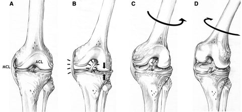 ACL Mechanism