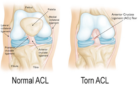 torn-acl-injruy