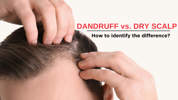 Dandruff vs. Dry Scalp: How to identify the difference? - iRestore Laser -  iRestore Hair Growth System