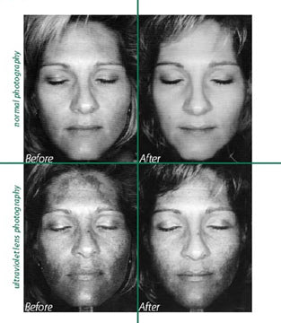 AFA Before and After Clinical Treatment South Surrey