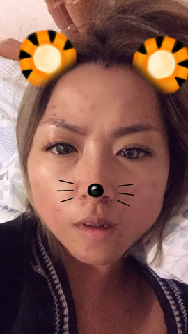 Chickenpox behind the Snapchat filter
