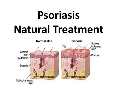 Psoriasis natural treatment image