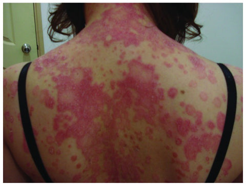 Woman with Psoriasis