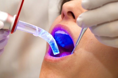 Photo of dental bleaching procedure at the dentist, not a kit
