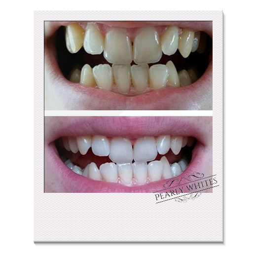 pearly whites teeth whitening sunderland