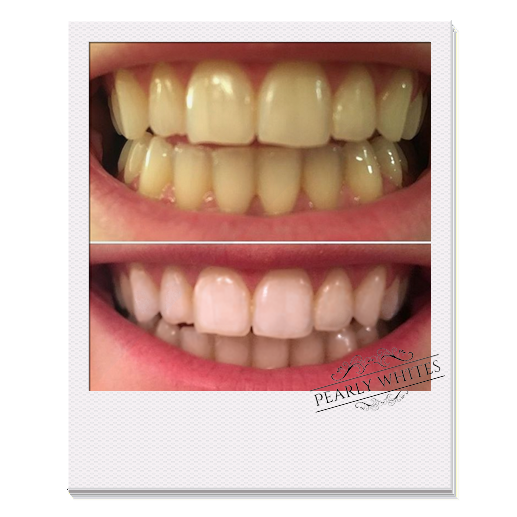 teeth whitening by laser reviews