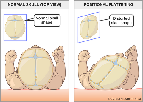 Flat head syndrome