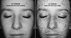 UV damaged skin