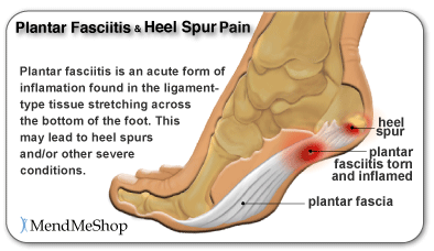 Plantar Fasciitis and Heel Spur Pain