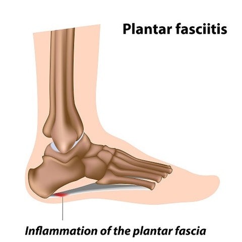 Therafit Drawing of foot with plantar fasciitis