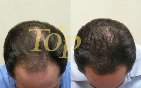 hair loss treatment before after