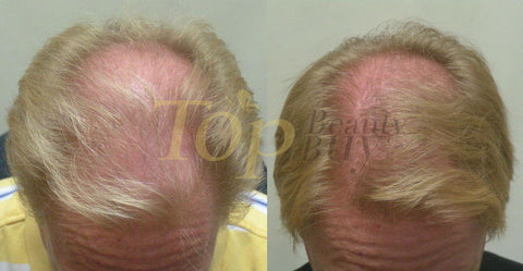 laser hair loss treatment before after