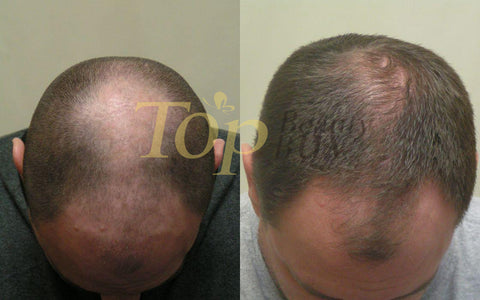 laser hair loss treatment before and after
