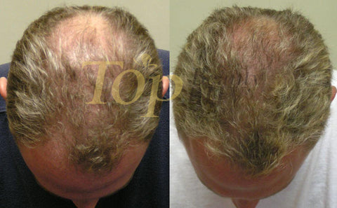 hair loss treatment before after