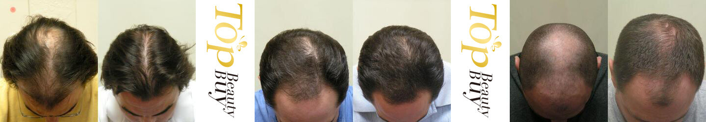 hair loss results