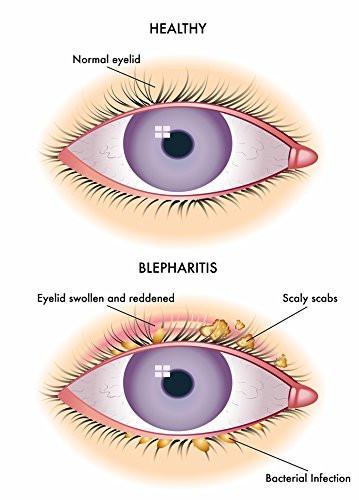 blepharitis eye mask