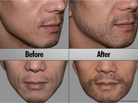 Beard Implant Before and After