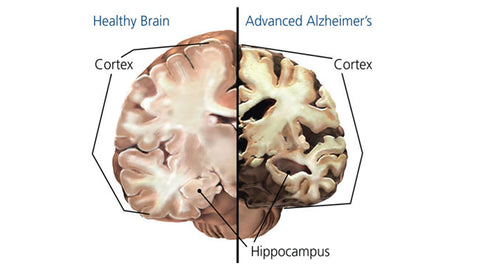 Alzheimer's Brain Comparison