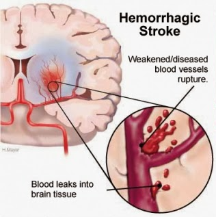 Vascular Dementia - Hemorrhagic Stroke