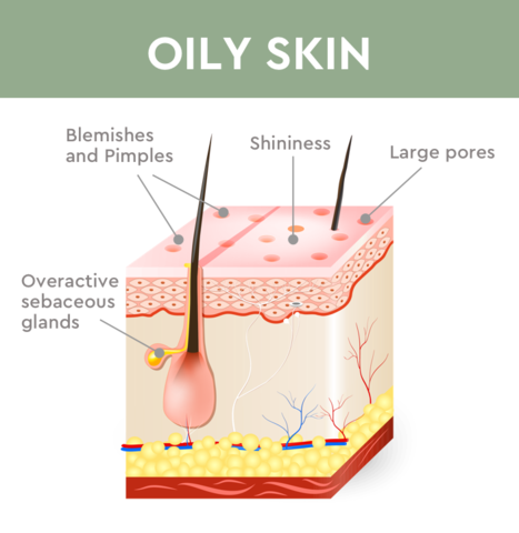 what causes oily skin