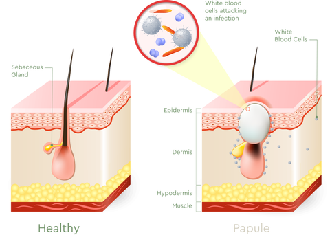 Inflammatory Acne - papule vs. healthy skin