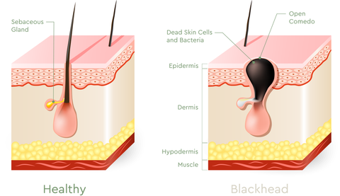 what type of acne do I have? Blackheads