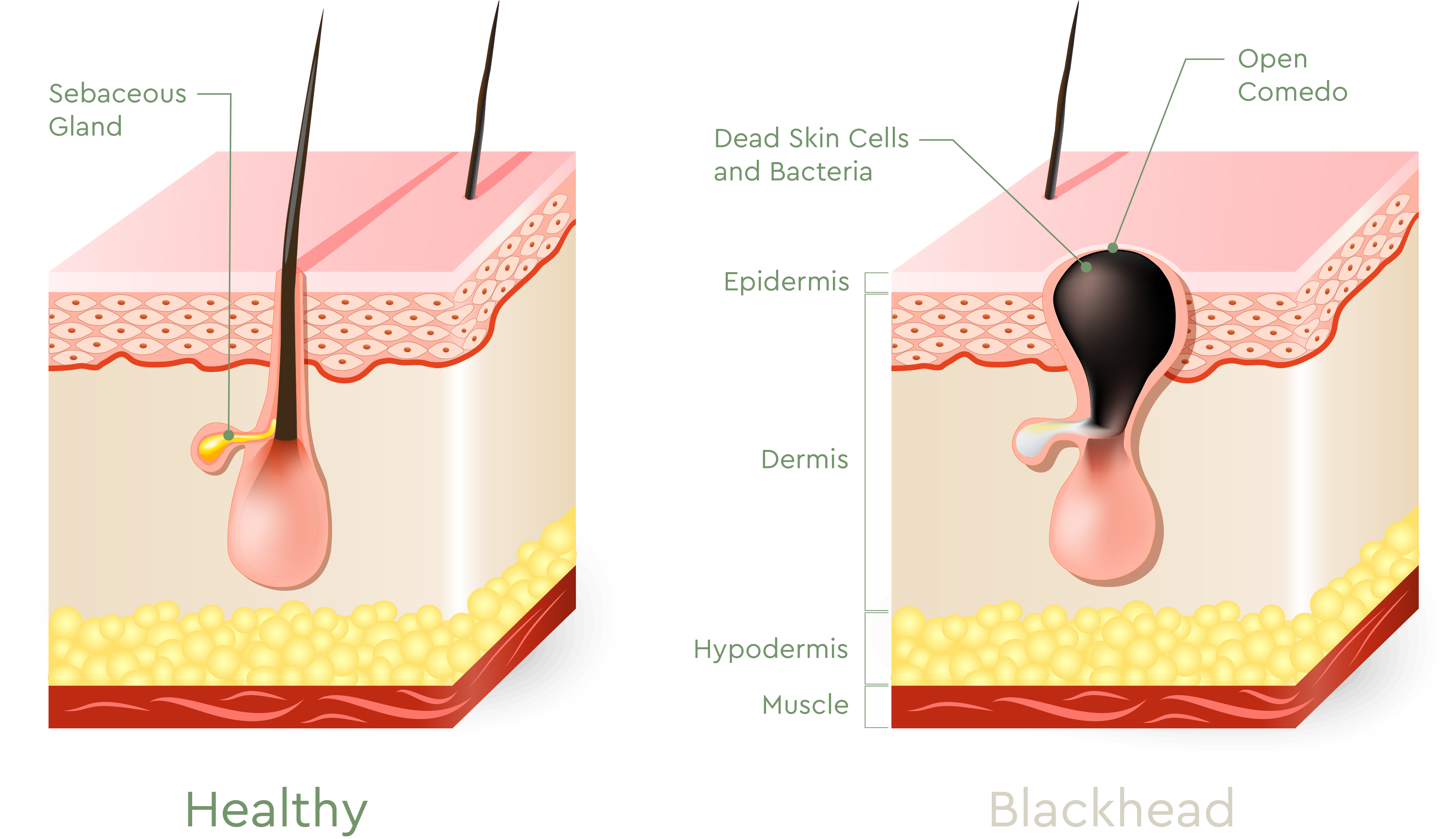 diagram of healthy pores vs. pores with blackheads