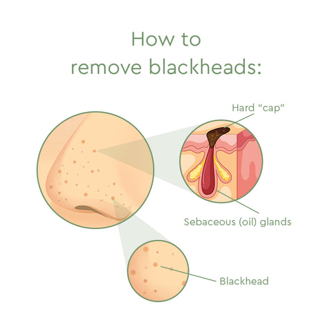 how to remove blackheads diagram