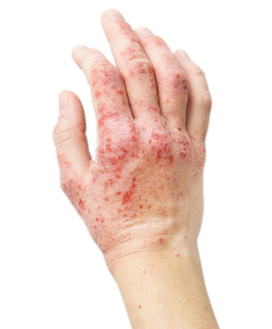 Eczema on hand