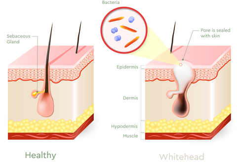Diagram of whiteheads vs healthy skin